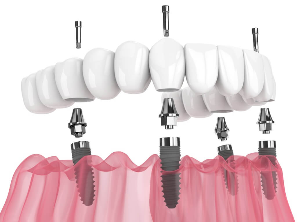 Full Zirconia Arches full arch implant treatment illustration
